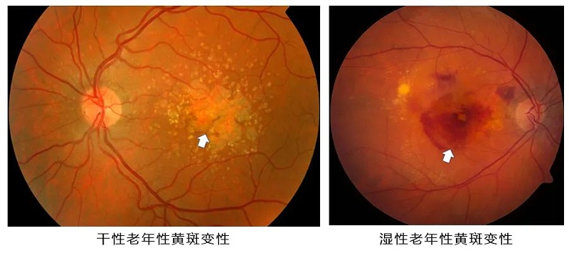 水蛭素、黃斑變性