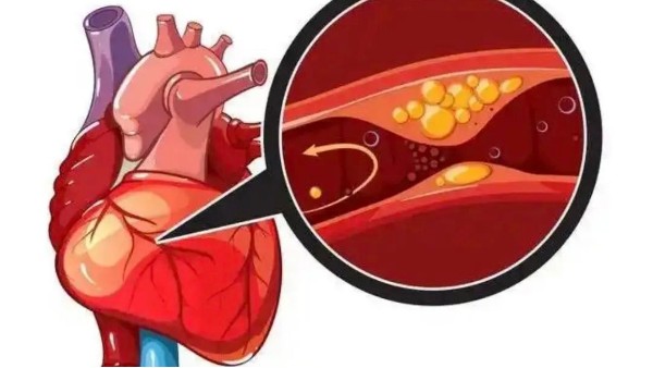 真實案例：是什么讓他堅持一年，冠狀動脈堵塞消除30%！