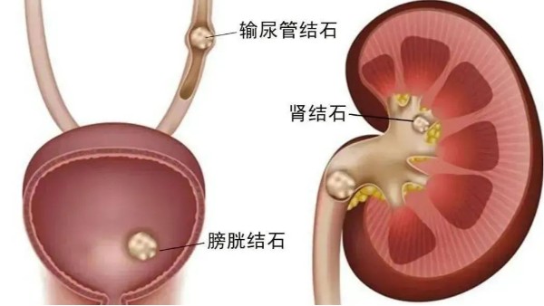 重用、活用水蛭治療尿路結(jié)石，療效較好