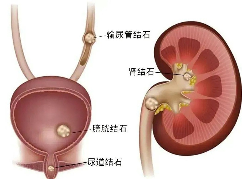 水蛭素、尿路結(jié)石、腎功能