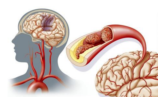 水蛭素、急性腦梗死、中風