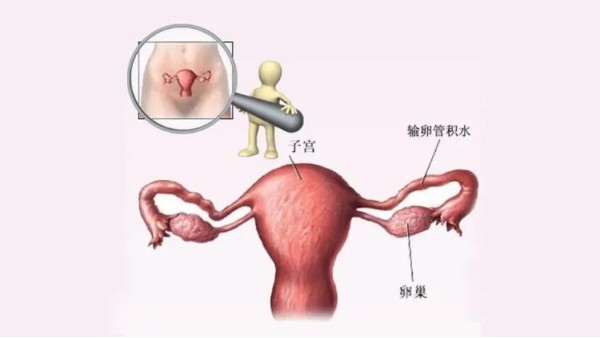 水蛭有利水道、破積聚之功，可用于治療輸卵管積水