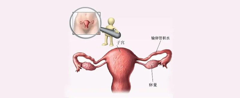 水蛭素、輸卵管積水、不孕不育