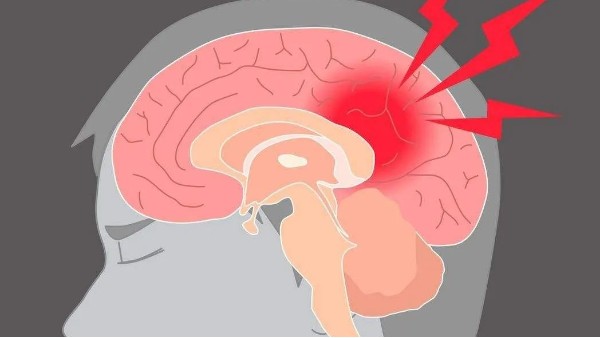 水蛭治療缺血性腦血管病療效肯定、安全簡便，已被各家公認