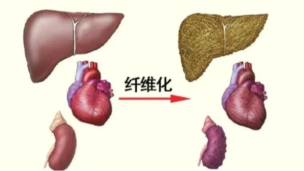 水蛭是臨床常用的活血藥物，能有效治療器官纖維化