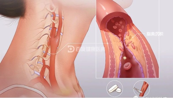 真實案例 | 從有到無，一個月多雙頸動脈斑塊“消失術”