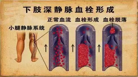 水蛭素、水蛭素膠囊、壯醫(yī)水蛭療法