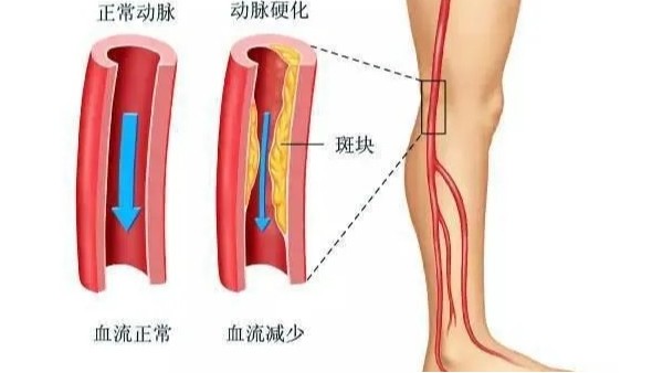 水蛭在改善下肢動(dòng)脈硬化性閉塞癥中發(fā)揮重要療效，安全性及可行性較高