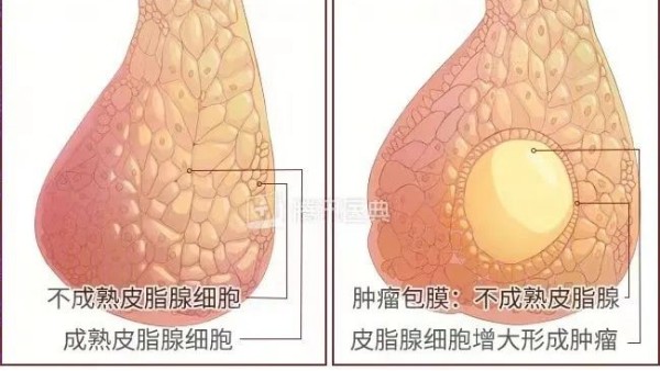 真實案例 | 腫瘤克星，百姓福音——現(xiàn)代壯醫(yī)水蛭療法