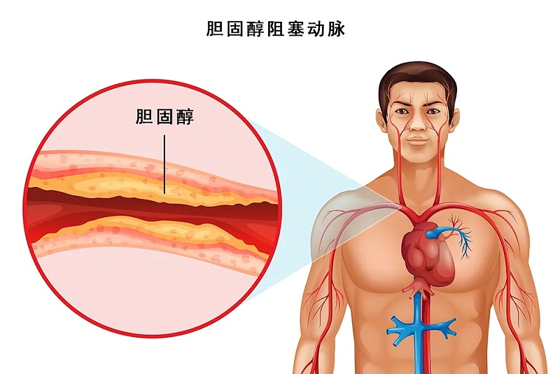 水蛭素、脖子粗、血管硬化