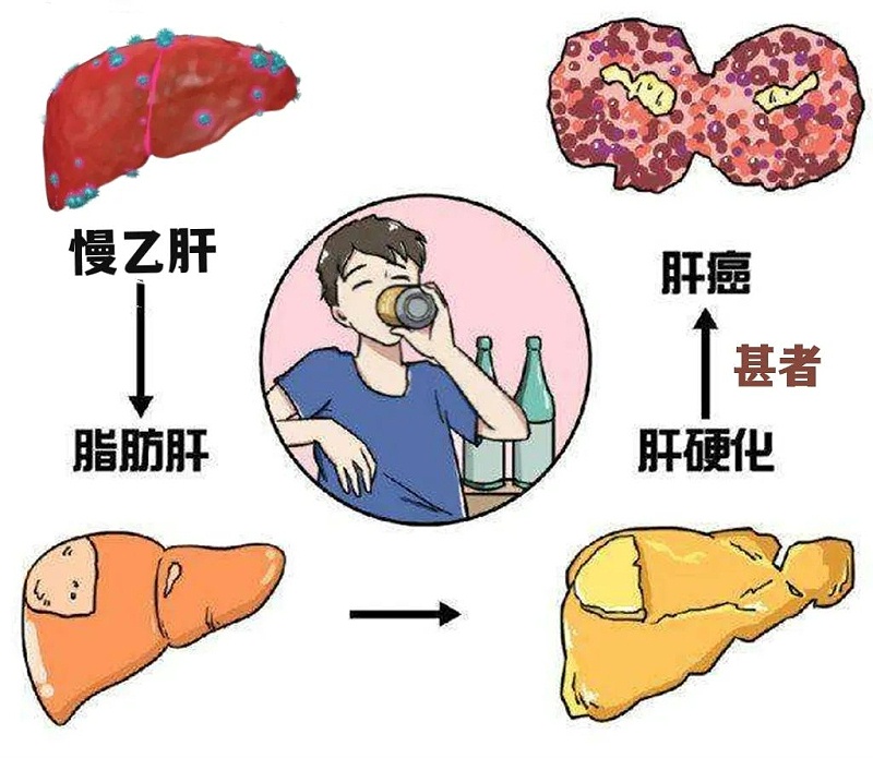 水蛭素、肝硬化、脂肪肝