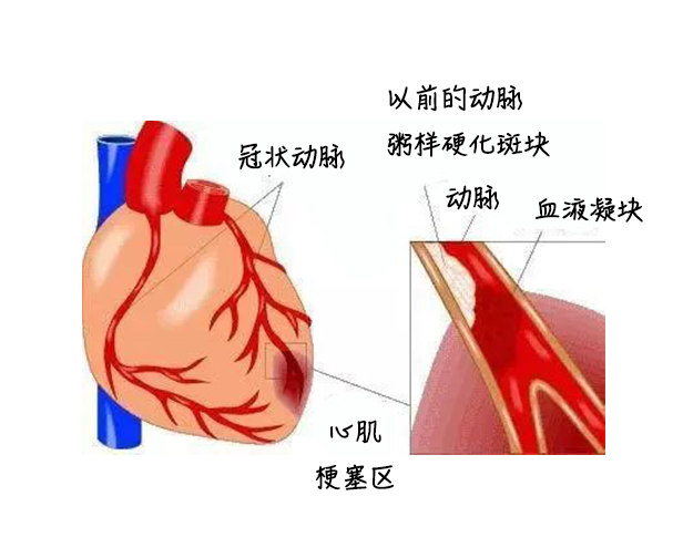 中醫(yī)藥健康旅游、心梗、面癱