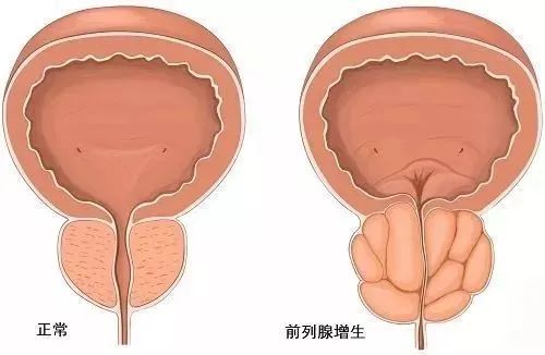 水蛭素、前列腺增生、前列腺肥大