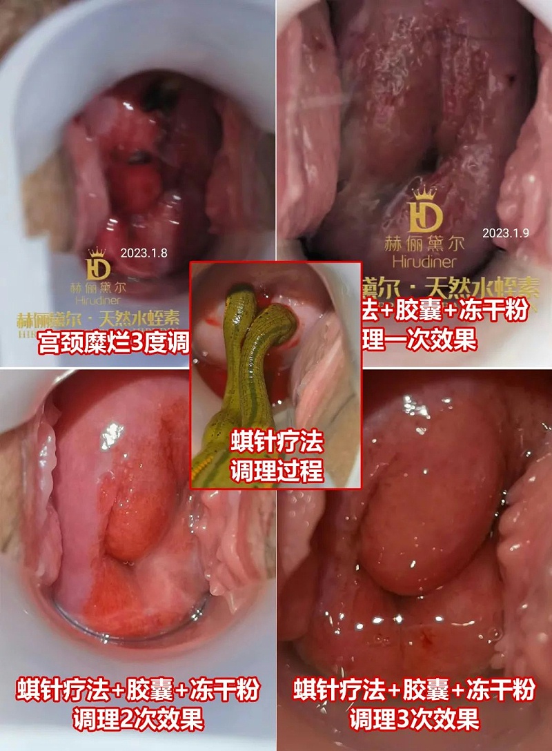 水蛭素、水蛭素膠囊、生殖婦科