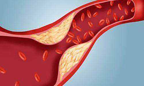 血管硬化的信號有哪些