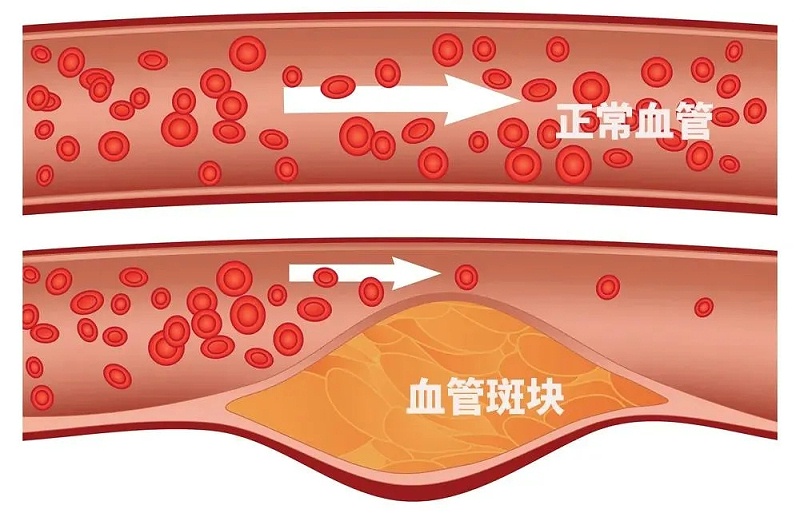 水蛭素、通血管、血管堵塞