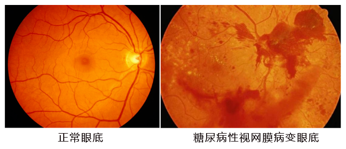 水蛭素、糖尿病、視網(wǎng)膜病變