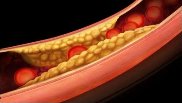 三高如何引起動脈粥樣硬化斑塊？——高血壓篇