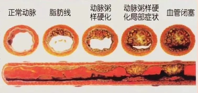 水蛭素、動(dòng)脈粥樣硬化、高血壓