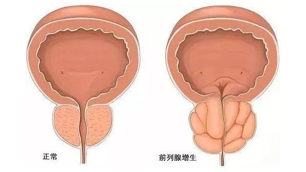 水蛭在改善前列腺增生臨床癥狀、提高生活質量方面發(fā)揮重要作用