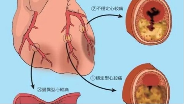 尿酸高不僅導致痛風，還可能威脅你的心臟和大腦！