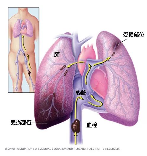 水蛭素、猝死、心梗